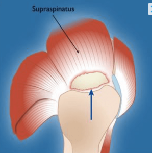 Rotator Cuff Tear