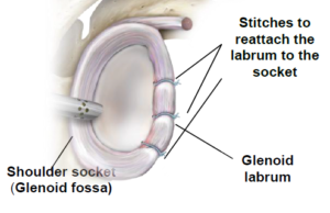 Shoulder Dislocation