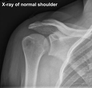 Normal Shoulder