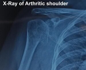 X Ray Shoulder