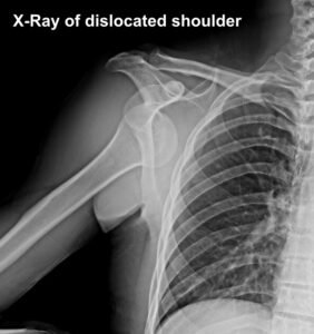 shoulder Dislocation