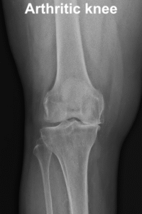 knee arthritis 2