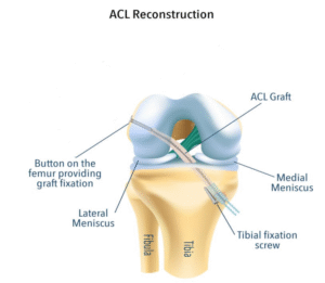 ACL Reconstruction