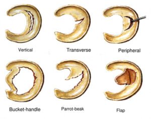 Meniscus Tear Image 2